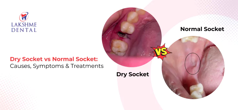 Dry Socket vs Healthy Socket: Symptoms Explained